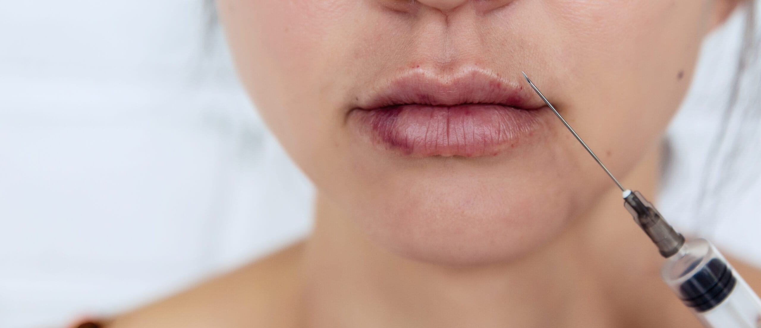 A woman experiencing bruising from lip fillers